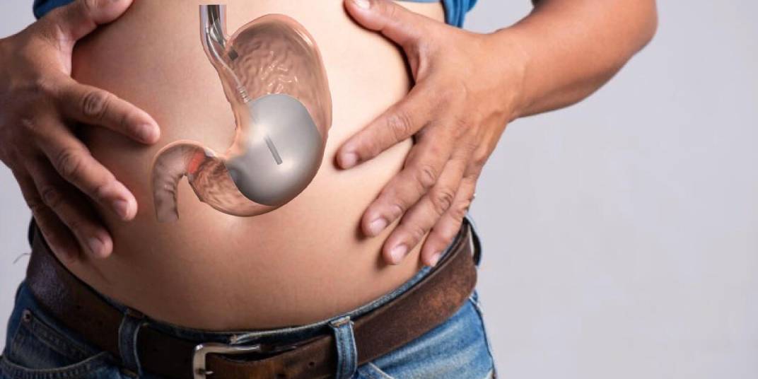 what-is-stomach-botox-and-how-is-it-applied