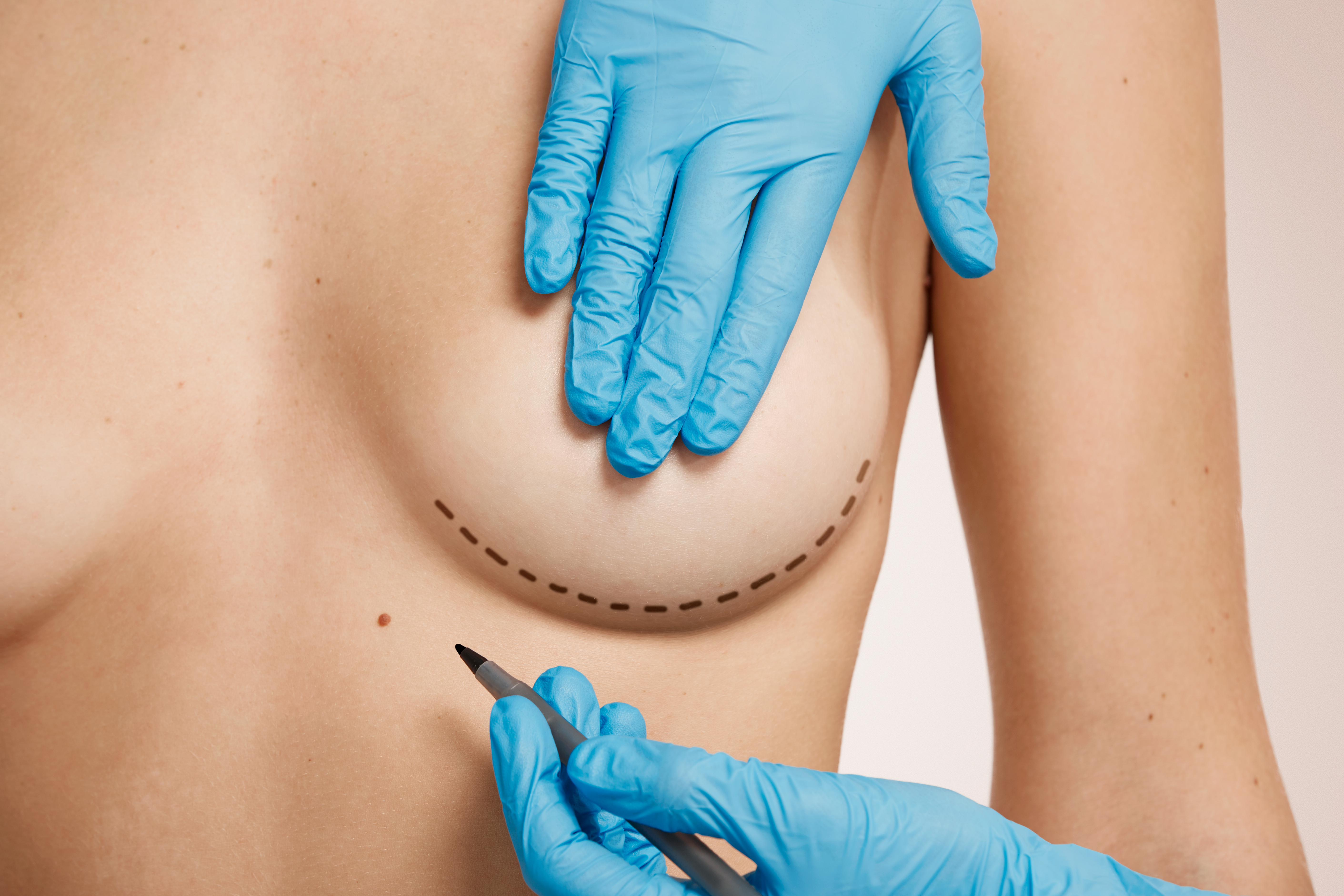 breast-lift-surgery-what-is-it-and-who-is-it-suitable-for